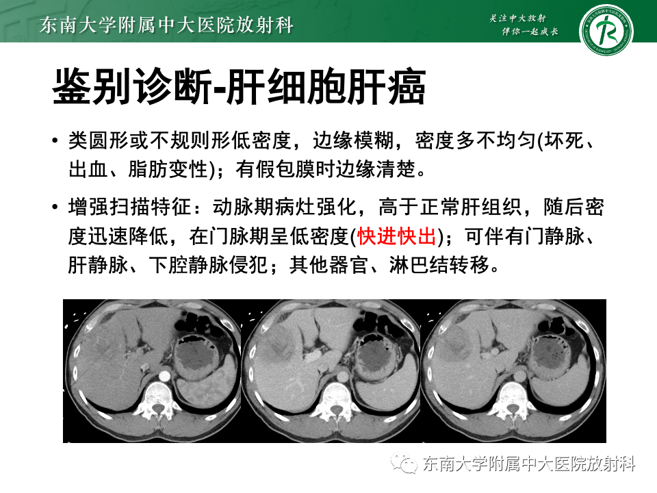 【PPT】肝细胞腺瘤-8