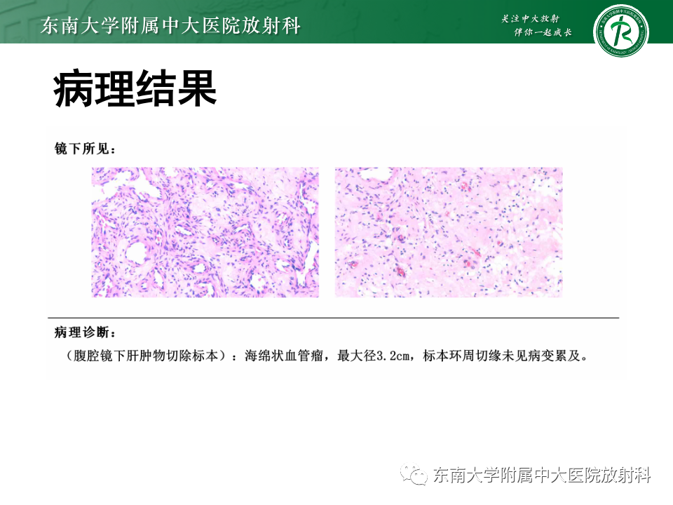 【PPT】肝细胞腺瘤-12