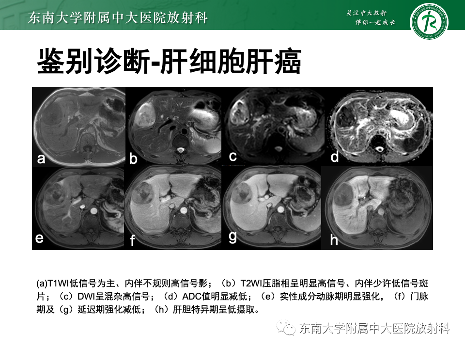 【PPT】肝细胞腺瘤-10
