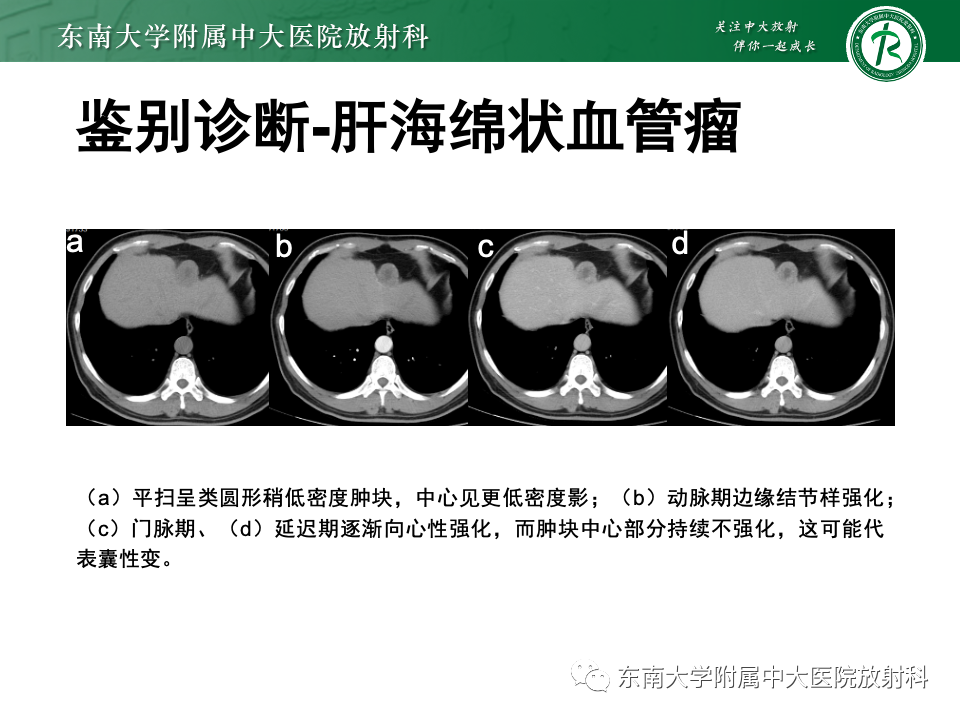 【PPT】肝细胞腺瘤-14