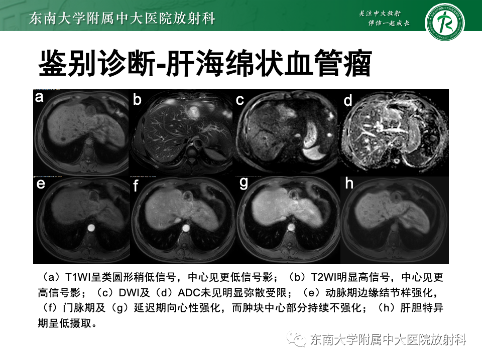 【PPT】肝细胞腺瘤-15