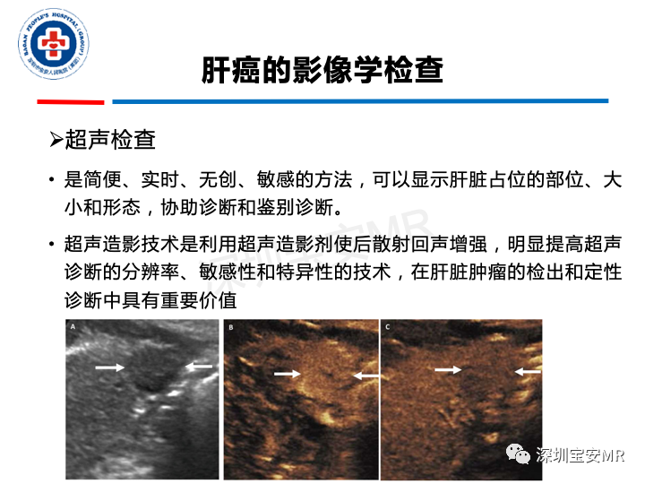 【PPT】原发性肝癌影像检查-7