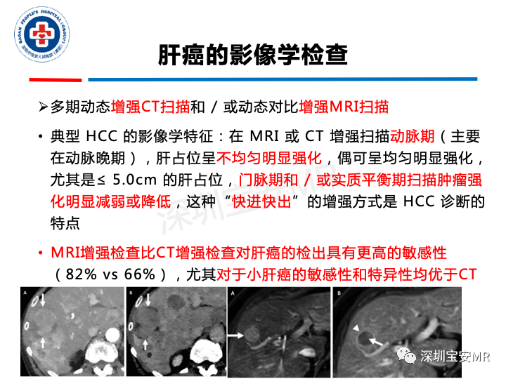 【PPT】原发性肝癌影像检查-8
