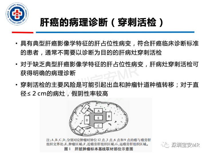 【PPT】原发性肝癌影像检查-10
