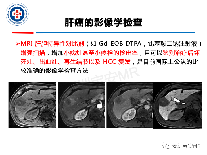 【PPT】原发性肝癌影像检查-9