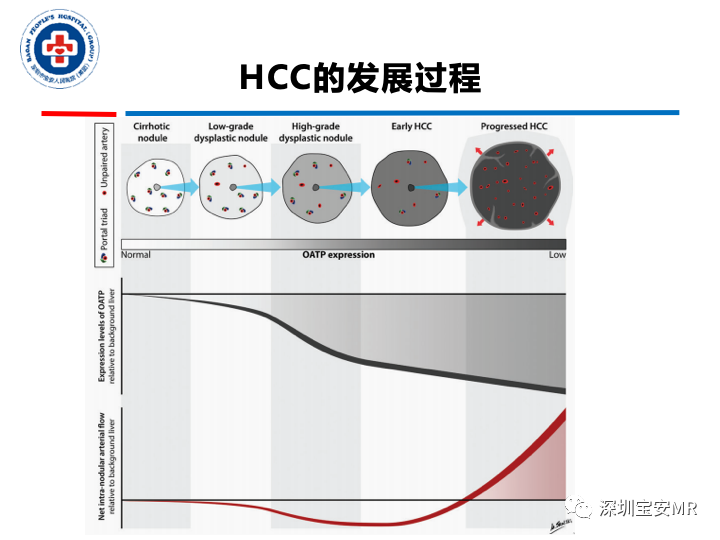 【PPT】原发性肝癌影像检查-11