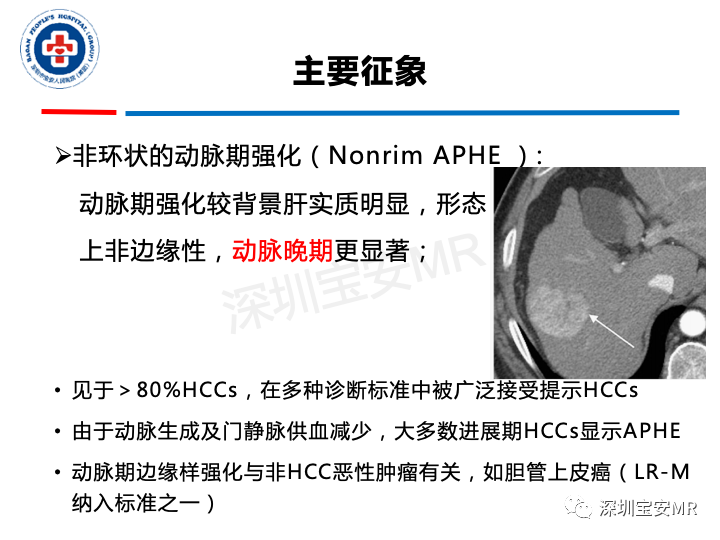 【PPT】原发性肝癌影像检查-19