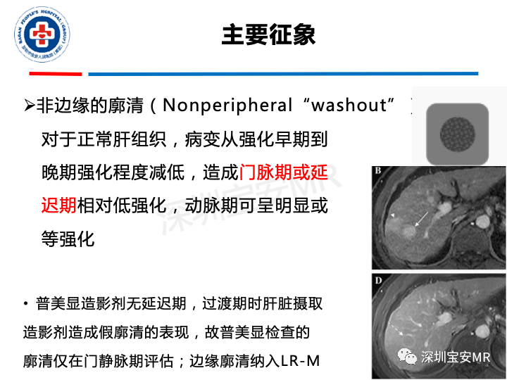 【PPT】原发性肝癌影像检查-20