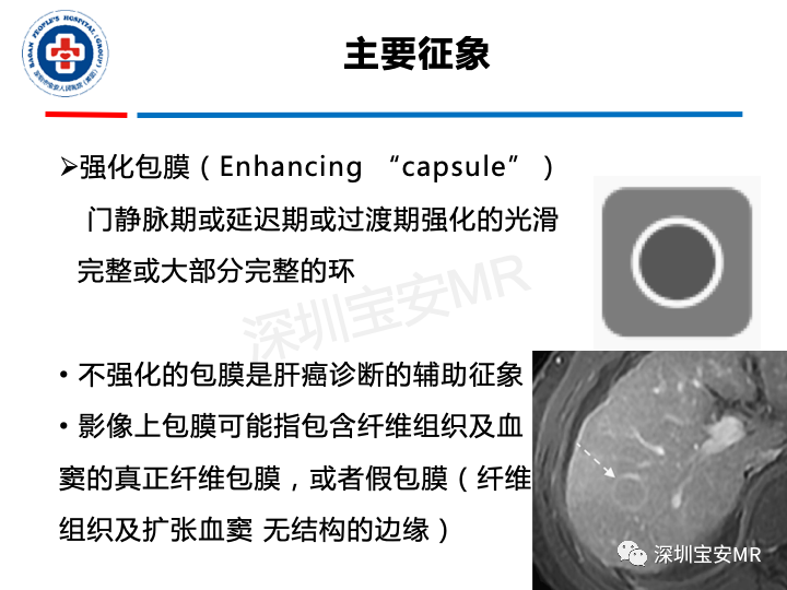 【PPT】原发性肝癌影像检查-21
