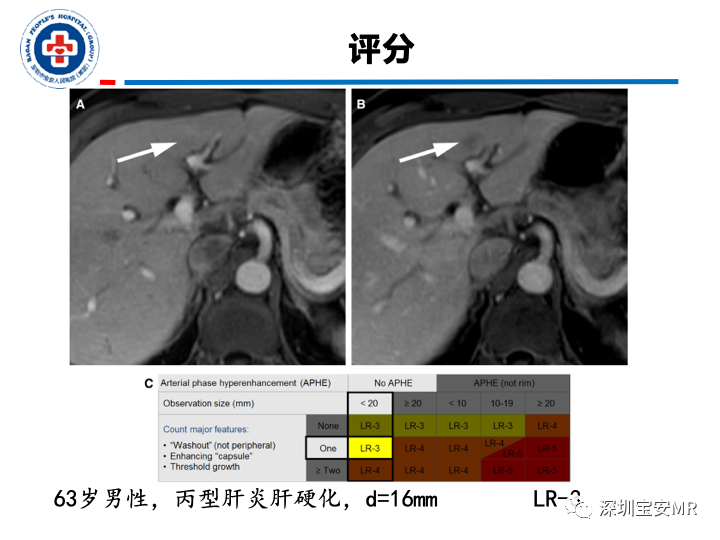 【PPT】原发性肝癌影像检查-26