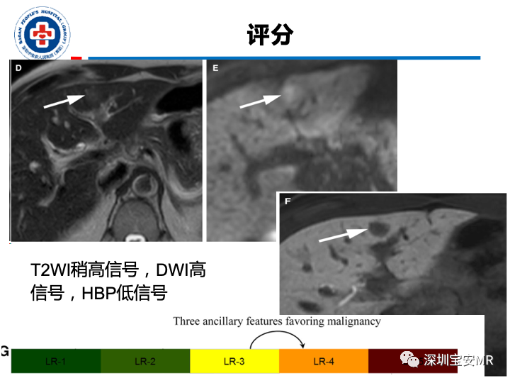 【PPT】原发性肝癌影像检查-27