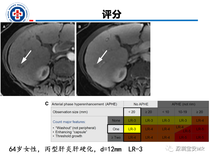 【PPT】原发性肝癌影像检查-28