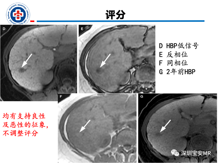 【PPT】原发性肝癌影像检查-29