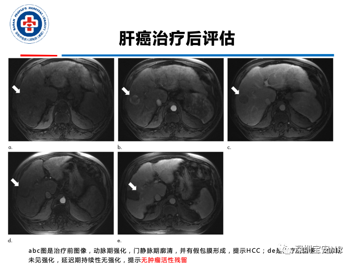 【PPT】原发性肝癌影像检查-34