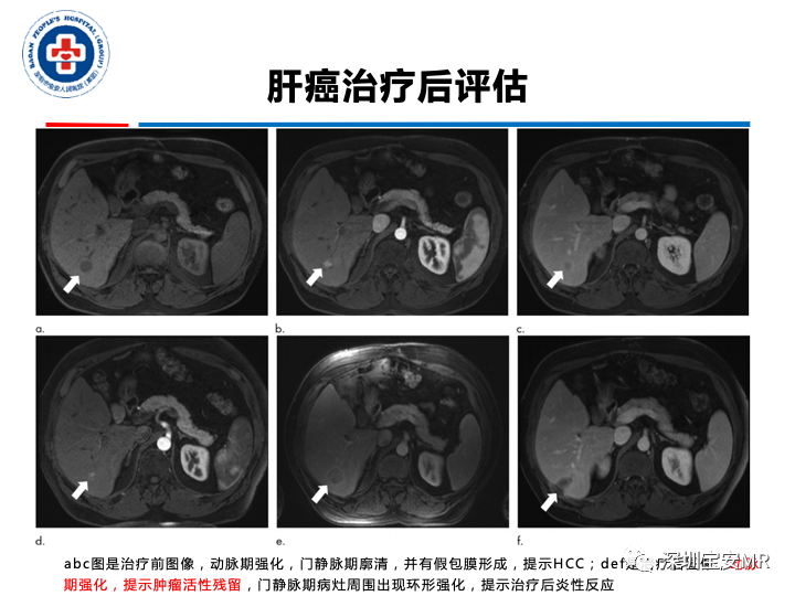 【PPT】原发性肝癌影像检查-35