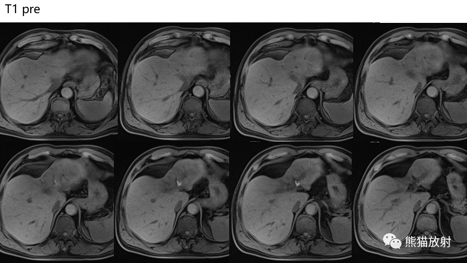 【PPT】肝内胆管细胞癌 VS 肝脓肿-5