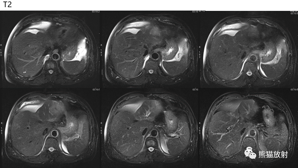 【PPT】肝内胆管细胞癌 VS 肝脓肿-4