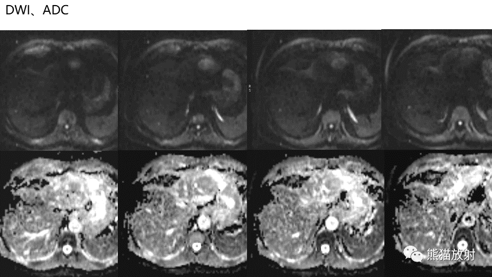 【PPT】肝内胆管细胞癌 VS 肝脓肿-8