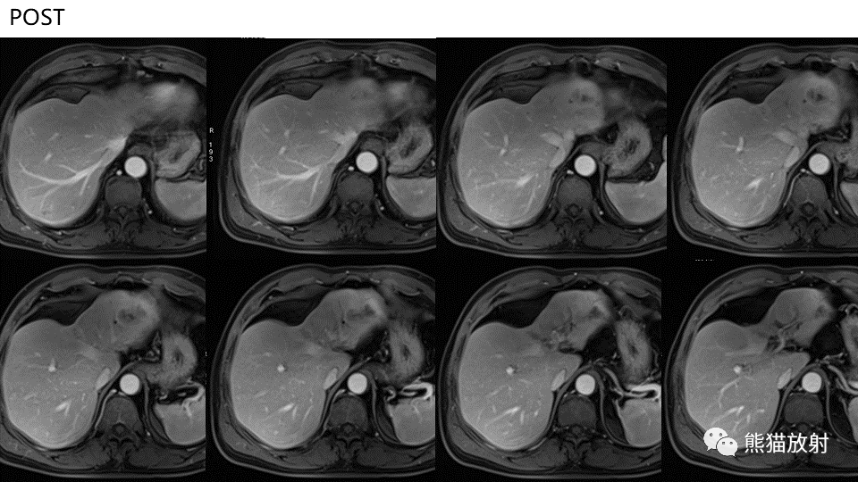【PPT】肝内胆管细胞癌 VS 肝脓肿-7