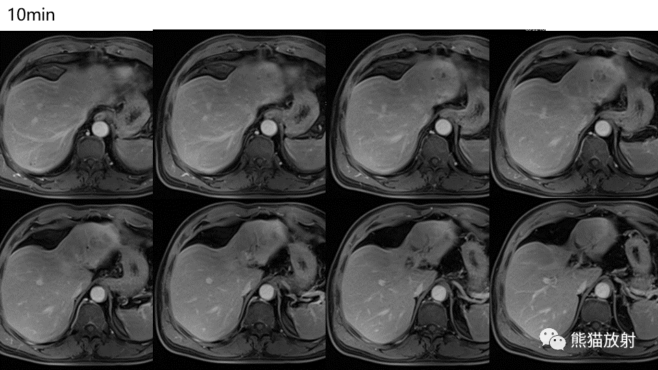 【PPT】肝内胆管细胞癌 VS 肝脓肿-9