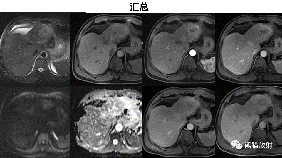 【PPT】肝内胆管细胞癌 VS 肝脓肿-11