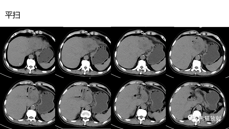 【PPT】肝内胆管细胞癌 VS 肝脓肿-16