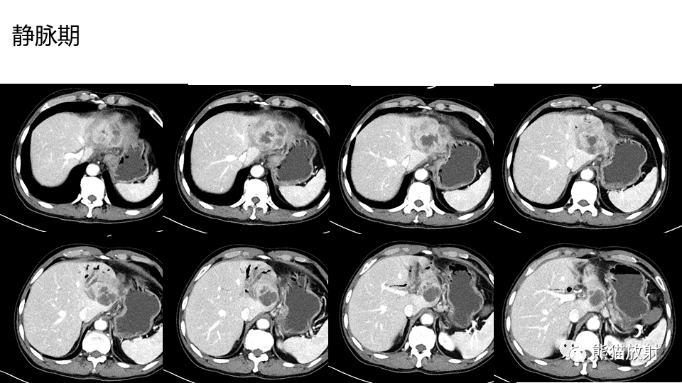 【PPT】肝内胆管细胞癌 VS 肝脓肿-18