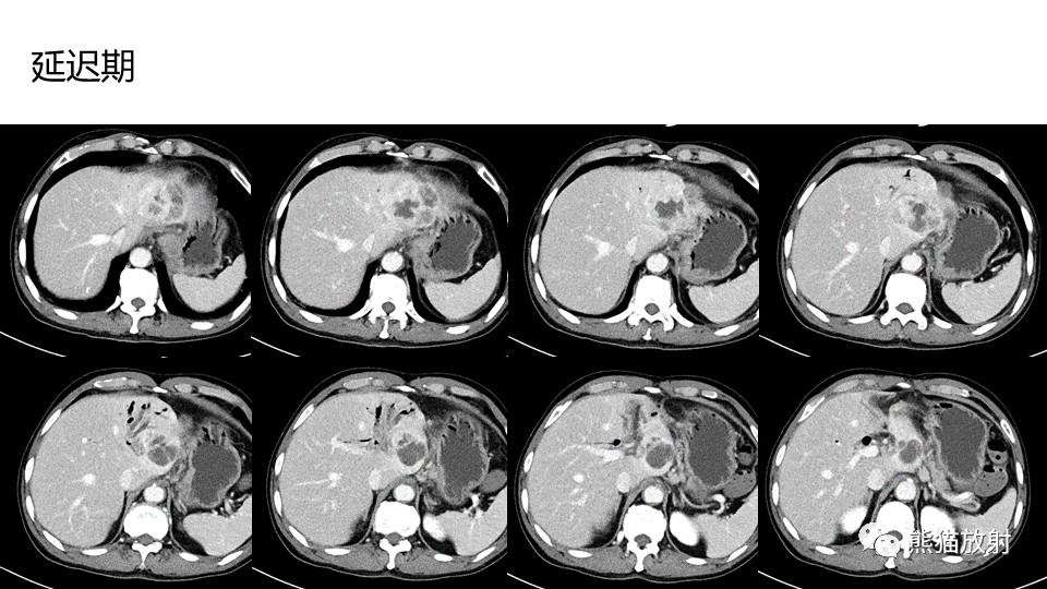 【PPT】肝内胆管细胞癌 VS 肝脓肿-19