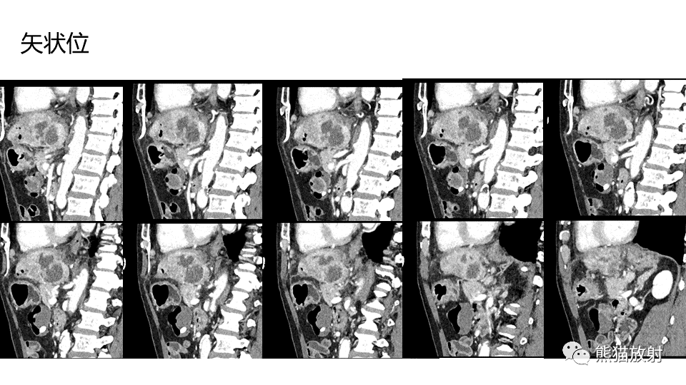 【PPT】肝内胆管细胞癌 VS 肝脓肿-21