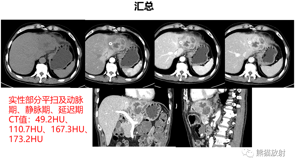 【PPT】肝内胆管细胞癌 VS 肝脓肿-22