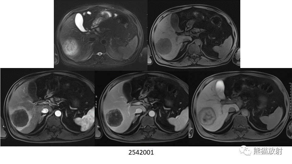 【PPT】肝内胆管细胞癌 VS 肝脓肿-29