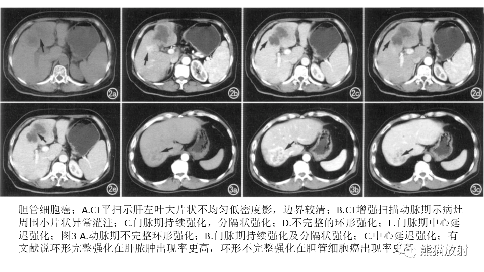 【PPT】肝内胆管细胞癌 VS 肝脓肿-30