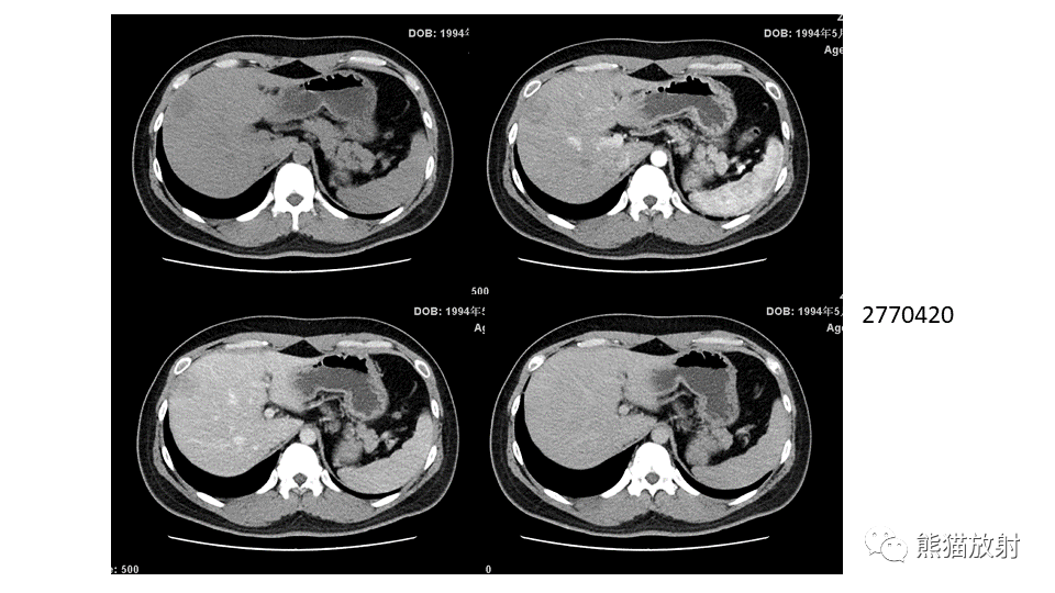 【PPT】肝内胆管细胞癌 VS 肝脓肿-34