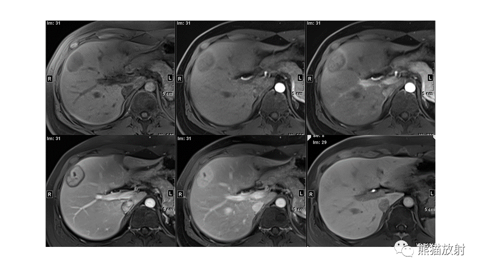 【PPT】肝内胆管细胞癌 VS 肝脓肿-35