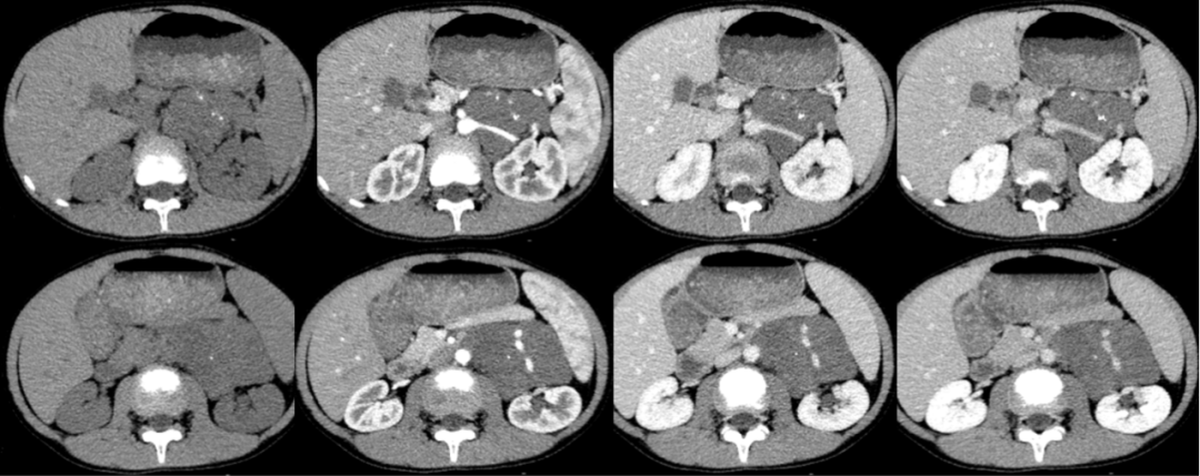 【病例】腹膜后可钙化的占位性病变,这两种疾病怎么鉴别?-1 【病例】腹膜后可钙化的占位性病变,这两种疾病怎么鉴别?-1