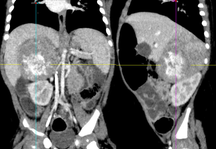 【病例】腹膜后可钙化的占位性病变,这两种疾病怎么鉴别?-4 【病例】腹膜后可钙化的占位性病变,这两种疾病怎么鉴别?-4