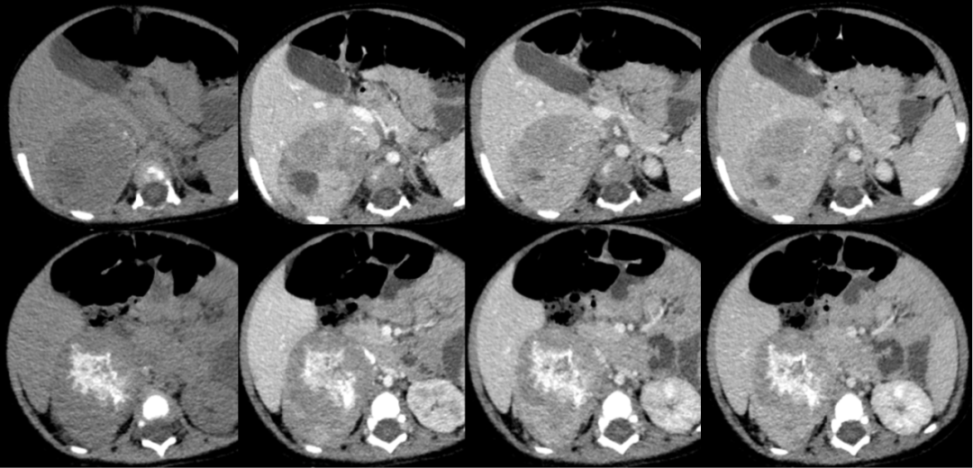 【病例】腹膜后可钙化的占位性病变,这两种疾病怎么鉴别?-3 【病例】腹膜后可钙化的占位性病变,这两种疾病怎么鉴别?-3