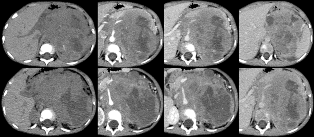 【病例】腹膜后可钙化的占位性病变,这两种疾病怎么鉴别?-5 【病例】腹膜后可钙化的占位性病变,这两种疾病怎么鉴别?-5