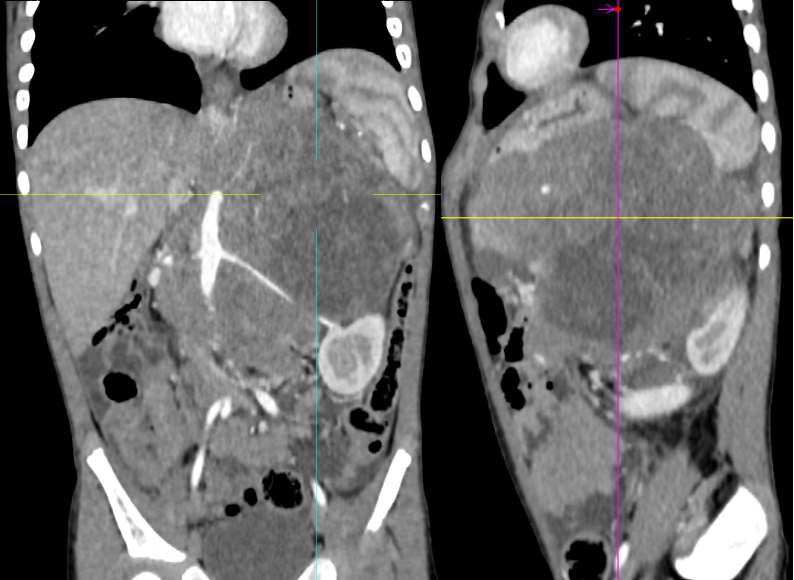 【病例】腹膜后可钙化的占位性病变,这两种疾病怎么鉴别?-6 【病例】腹膜后可钙化的占位性病变,这两种疾病怎么鉴别?-6