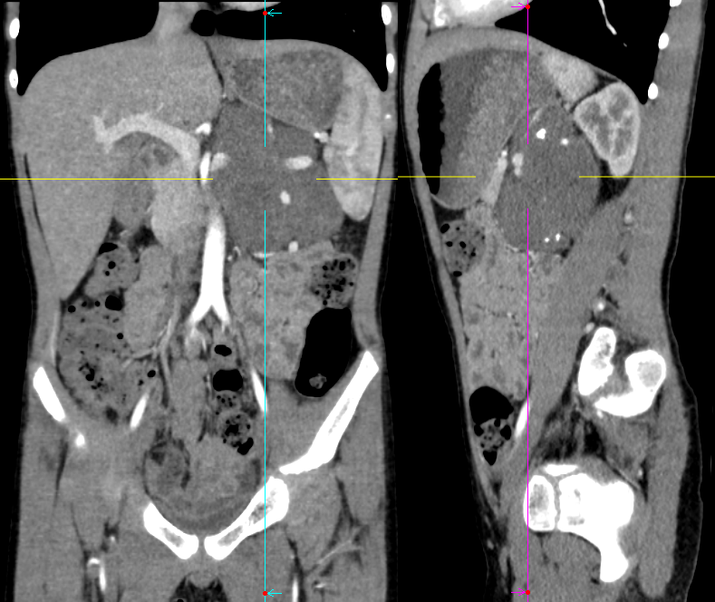 【病例】腹膜后可钙化的占位性病变,这两种疾病怎么鉴别?-2 【病例】腹膜后可钙化的占位性病变,这两种疾病怎么鉴别?-2