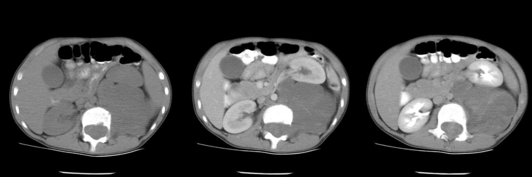【病例】腹膜后可钙化的占位性病变,这两种疾病怎么鉴别?-7 【病例】腹膜后可钙化的占位性病变,这两种疾病怎么鉴别?-7