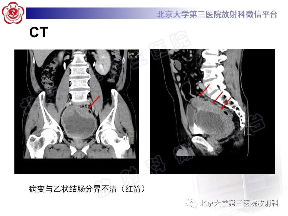 【PPT】胃肠道间质瘤-5