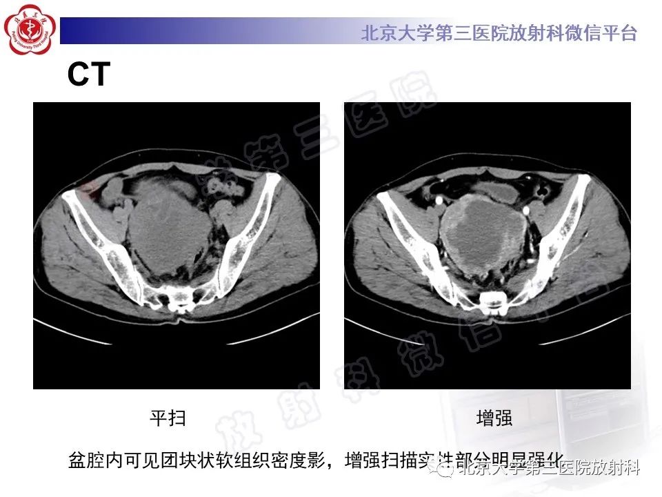 【PPT】胃肠道间质瘤-3