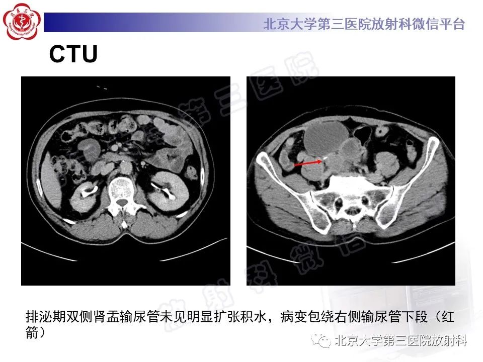 【PPT】胃肠道间质瘤-4