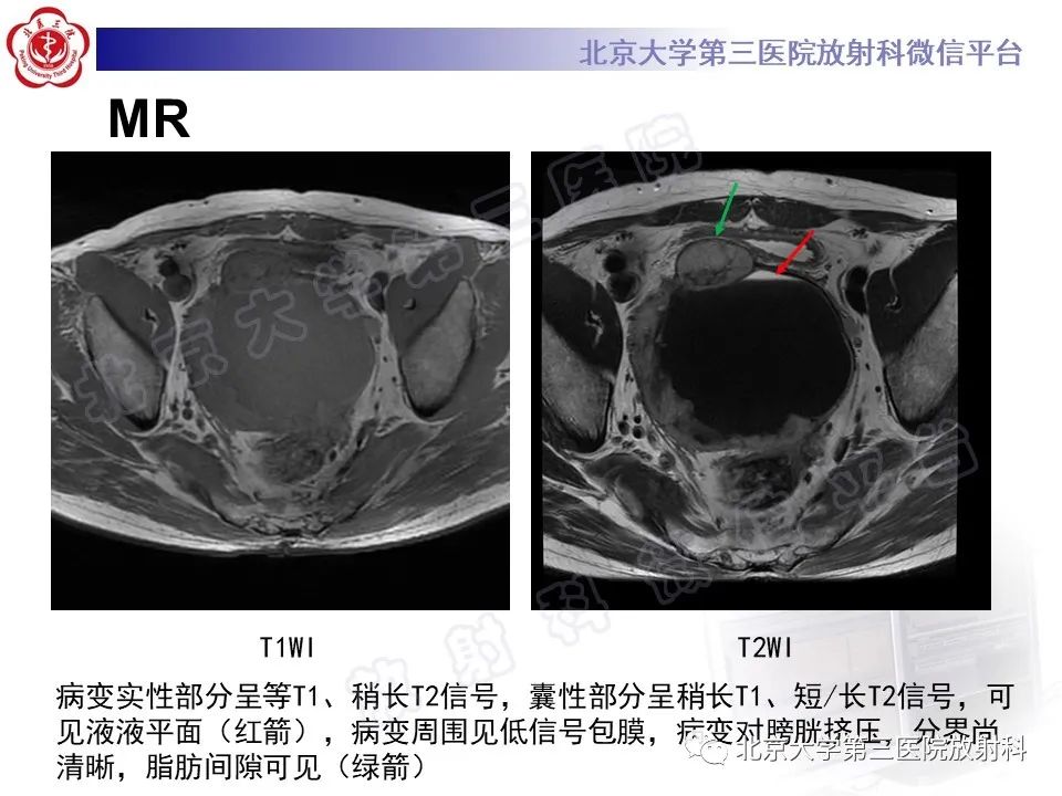 【PPT】胃肠道间质瘤-6