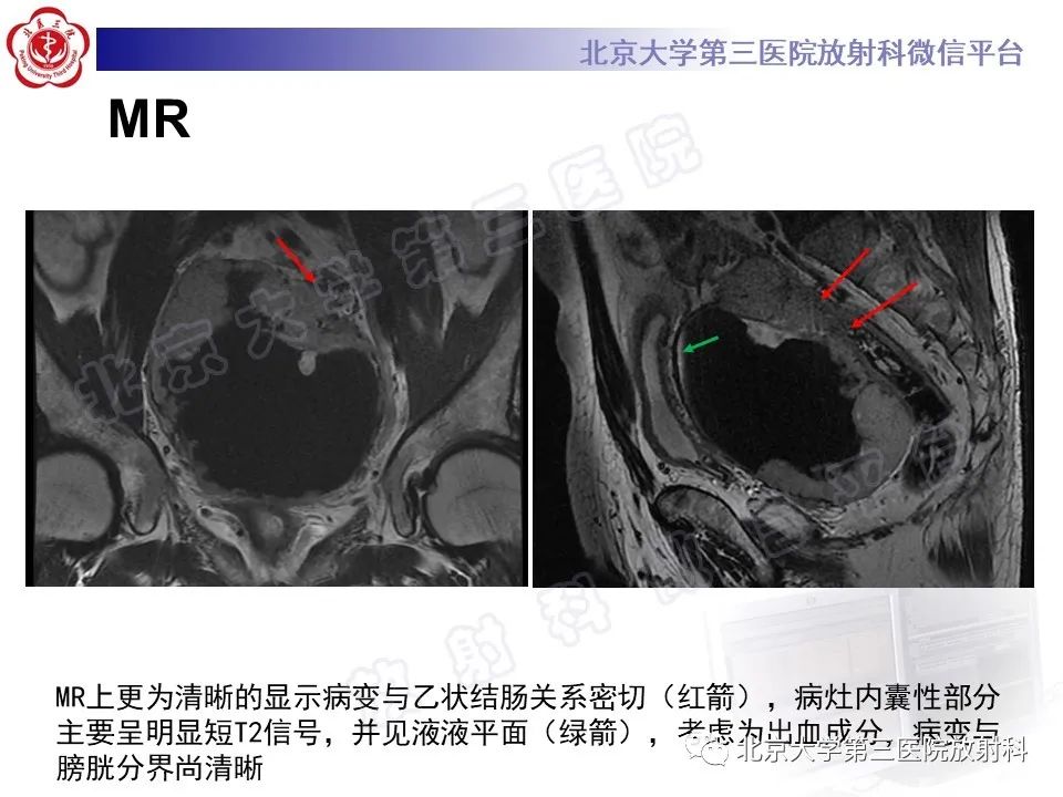 【PPT】胃肠道间质瘤-8