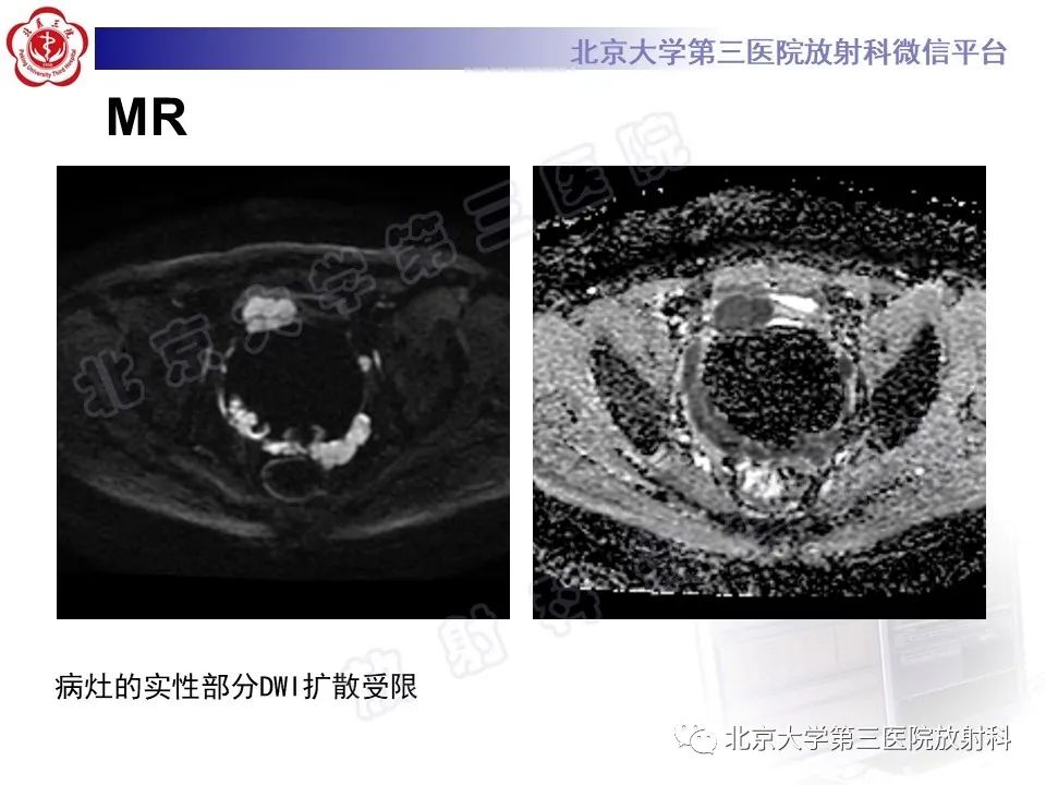 【PPT】胃肠道间质瘤-7