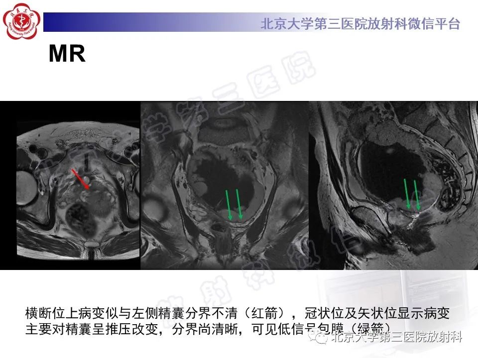 【PPT】胃肠道间质瘤-9