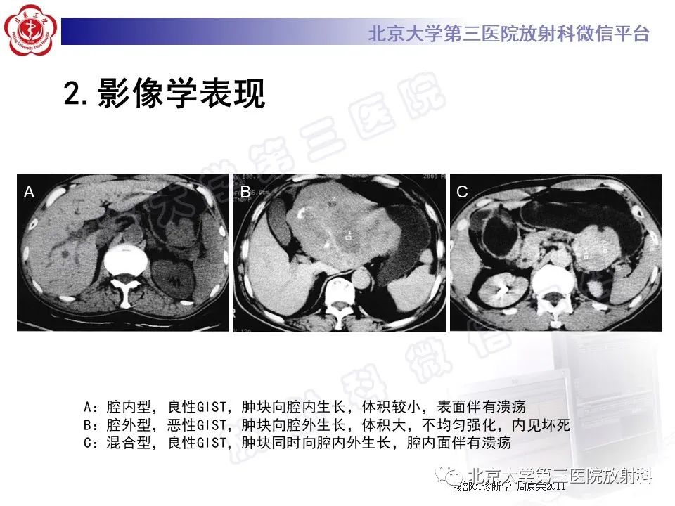【PPT】胃肠道间质瘤-18
