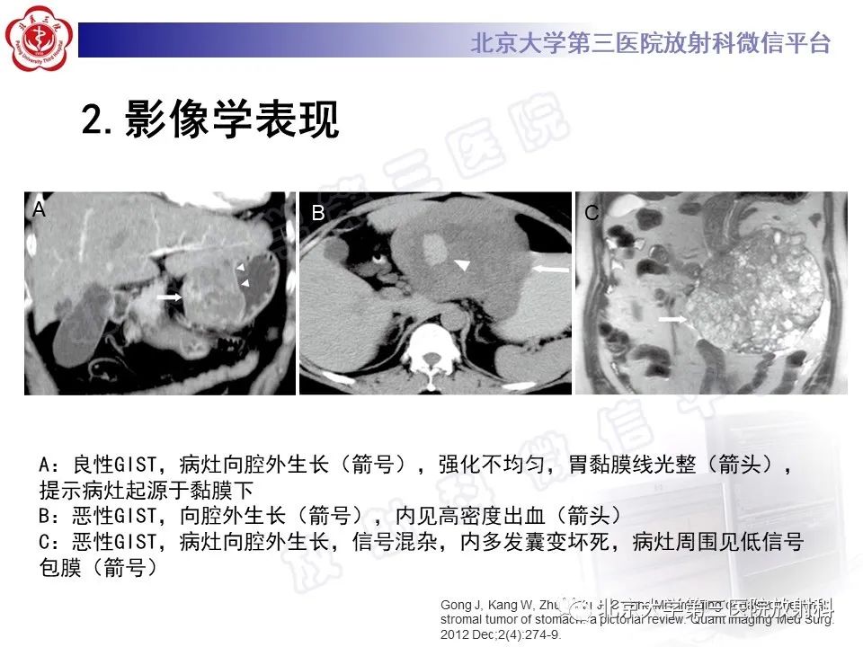 【PPT】胃肠道间质瘤-19